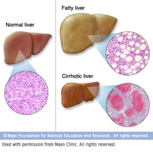 A diagram showing the makeup of a healthy liver versus a fatty liver versus a cirrhotic liver.