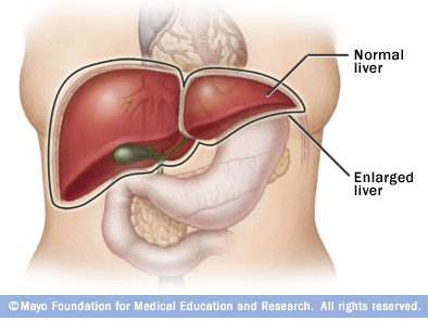 A diagram showing the size of an enlarged liver compared to the regular size of a healthy liver