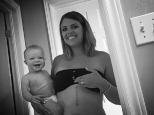 A mom holds her baby son and shows a long scar on her abdomen