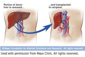A diagram showing that a portion of one liver is