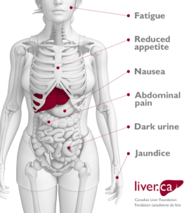 Une illustration montrant quelques signes courants de l’hépatite C, dont la fatigue, la baisse d’appétit, la nausée, la douleur abdominale, l’urine foncée et la jaunisse.