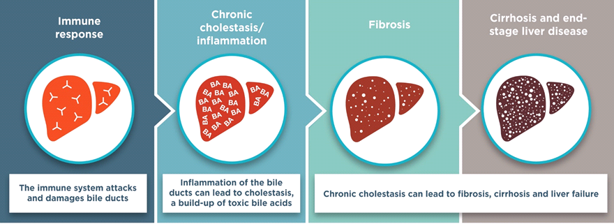 A graphic showing Immune Response, Chronic cholestasis/inflammation, fibrosis, and cirrhosis and end-stage liver disease. Image used with permission from Intercept Pharma.