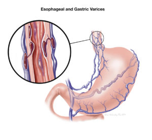 An illustration of the esophageal and gastric varices