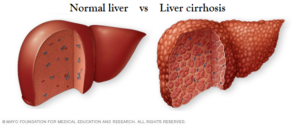 An illustration of a normal liver compared to liver cirrhosis. Image used with permission by Mayo Clinic