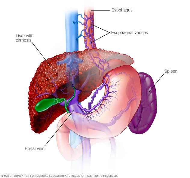 An illustration showing what the liver looks like with cirrhosis, including varices where variceal bleeding occurs
