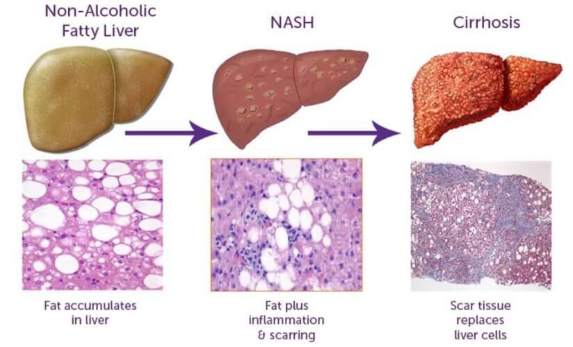 NASH Canadian Liver Foundation