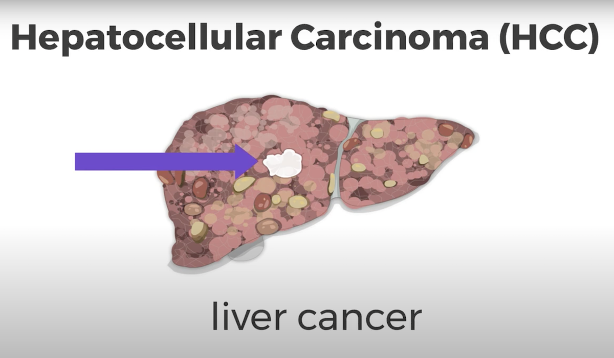 Cirrhosis and Liver Cancer Canadian Liver Foundation