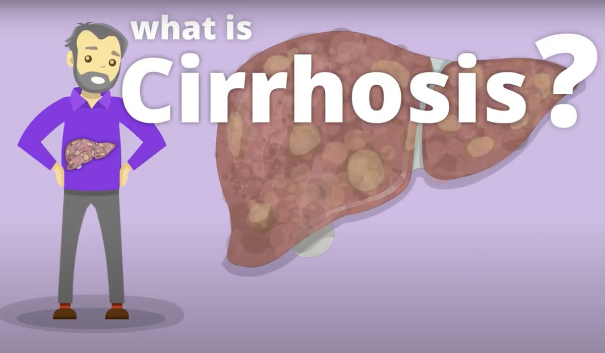 What is Cirrhosis? Canadian Liver Foundation
